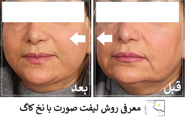 معرفی روش لیفت صورت با نخ کاگ
