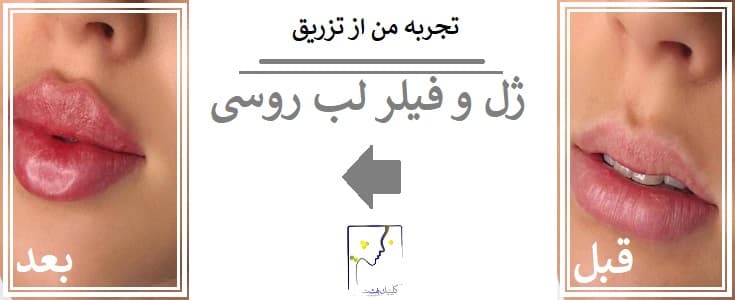 تجربه من از تزریق ژل و فیلر لب روسی