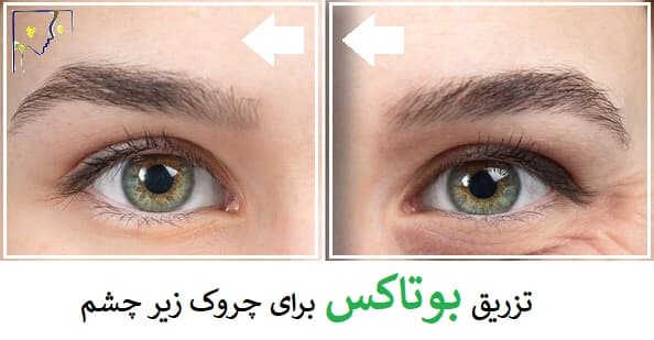 تزریق بوتاکس برای چروک زیر چشم
