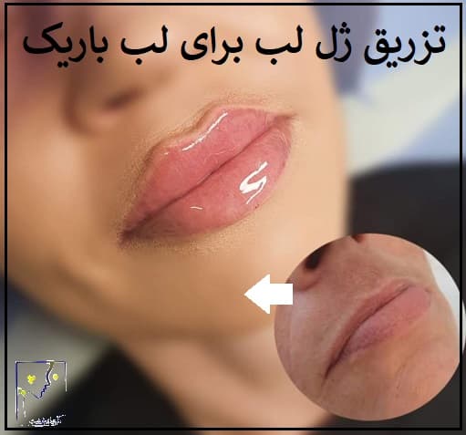 تزریق ژل لب برای لب باریک
