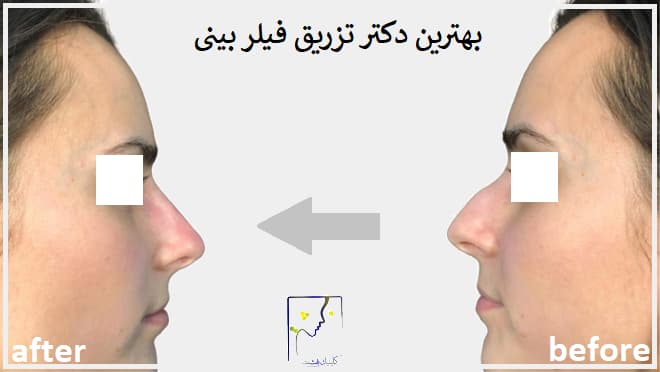 بهترین دکتر تزریق فیلر بینی