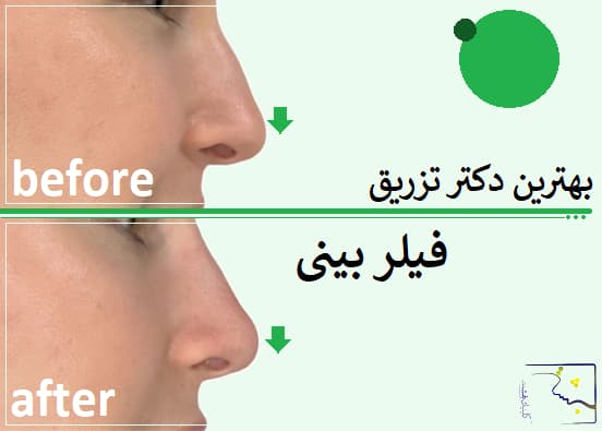 بهترین دکتر تزریق فیلر بینی