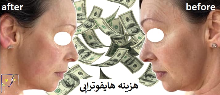 هزینه هایفوتراپی