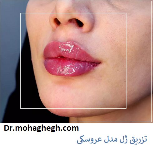تزریق ژل مدل عروسکی