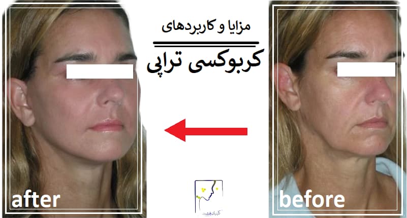مزایا و کاربردهای کربوکسی تراپی