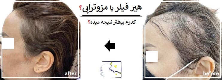 هیر فیلر یا مزوتراپی؟ کدوم بیشتر نتیجه میده؟