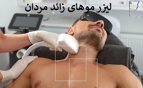 لیزر موهای زائد مردان