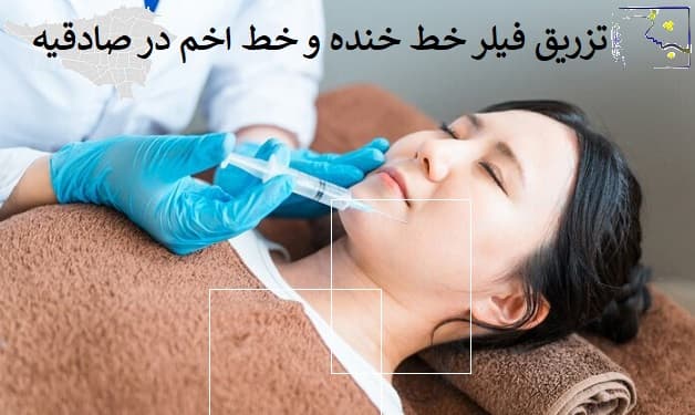 تزریق فیلر خط خنده و خط اخم در صادقیه