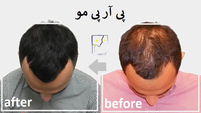 پی آر پی مو