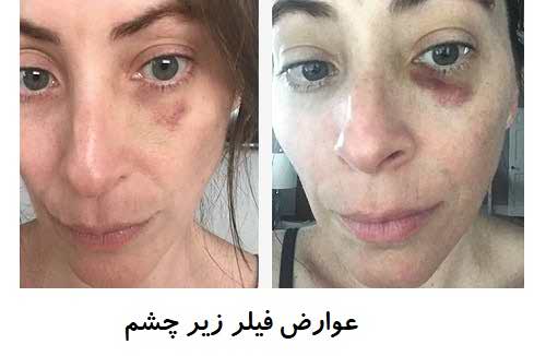 معایب تزریق فیلر زیر چشم چیست؟