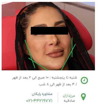 زاویه سازی صورت در صادقیه