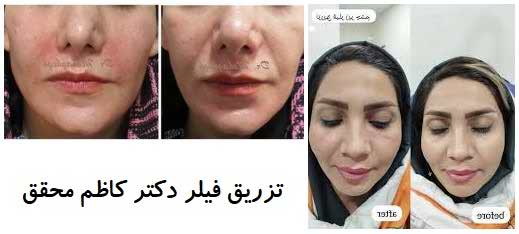 تزریق فیلر درکتر کاظم محقق