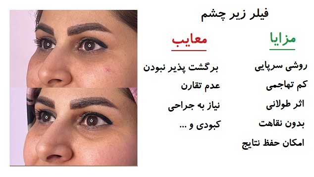 مزایا و معایب فیلر زیر چشم