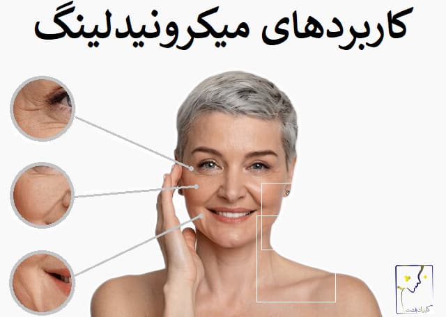 کاربردهای میکرونیدلینگ