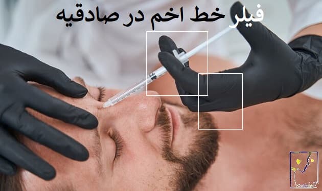 فیلر خط اخم در صادقیه