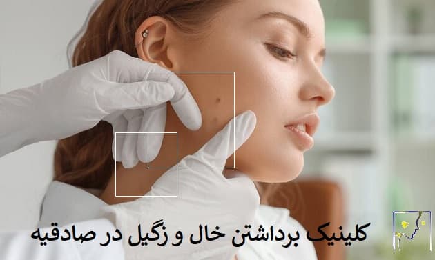 کلینیک برداشتن خال و زگیل در صادقیه