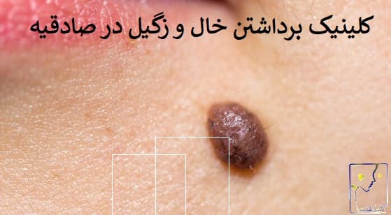 کلینیک برداشتن خال و زگیل در صادقیه