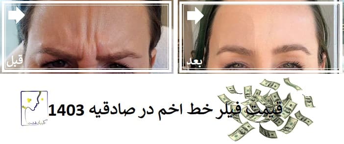 قیمت فیلر خط اخم در صادقیه 1403