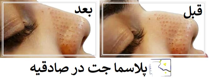 پلاسما جت در صادقیه