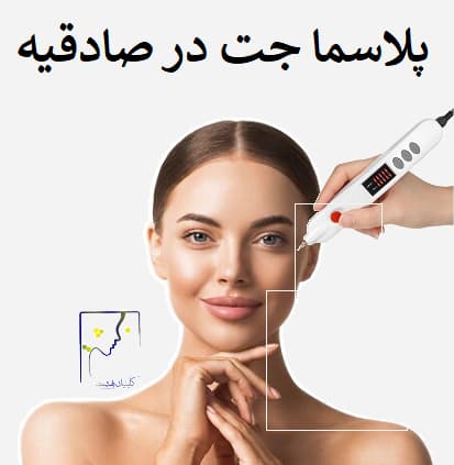 پلاسما جت در صادقیه