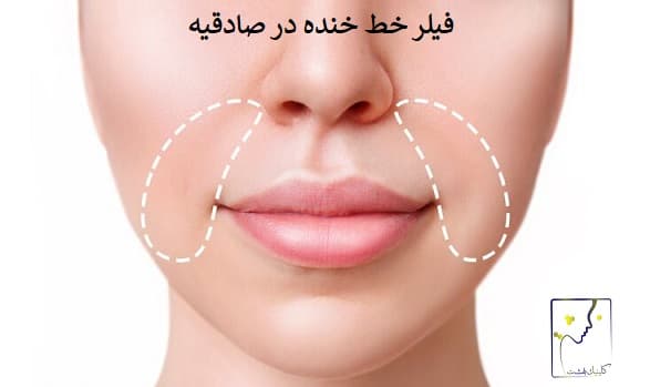 فیلر خط خنده در صادقیه