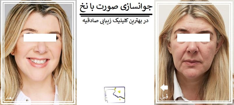 جوانسازی صورت با نخ در بهترین کلینیک زیبایی صادقیه
