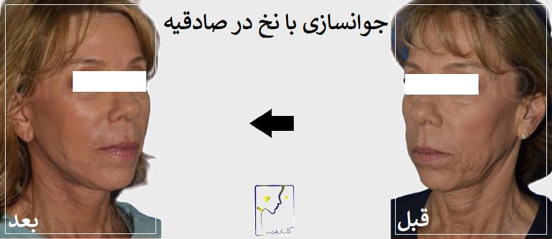 جوانسازی با نخ در صادقیه