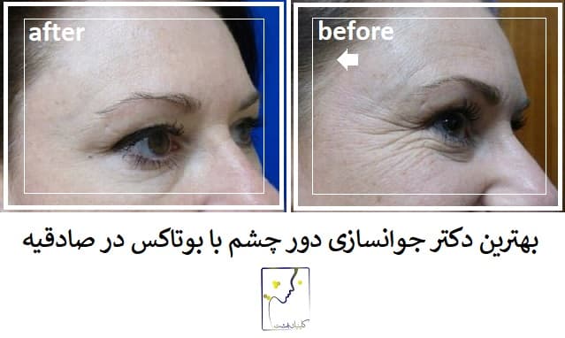 بهترین دکتر جوانسازی دور چشم با بوتاکس در صادقیه
