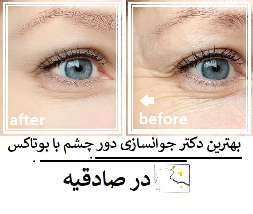 بهترین دکتر جوانسازی دور چشم با بوتاکس در صادقیه