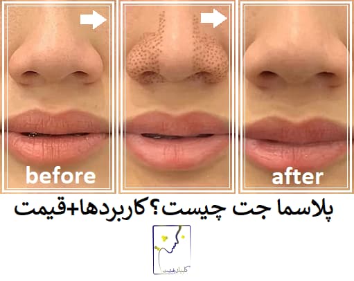 پلاسما جت چیست؟کاربردها+قیمت