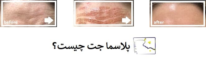 پلاسما جت چیست؟