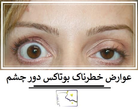 عوارض خطرناک بوتاکس دور چشم