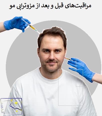مراقبت‌های قبل و بعد از مزوتراپی مو