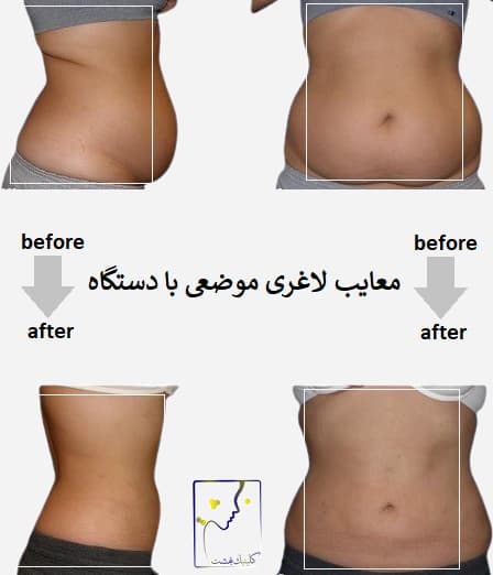 معایب لاغری موضعی با دستگاه