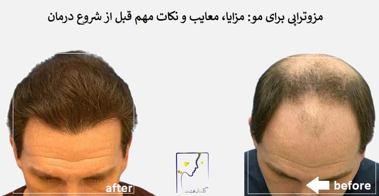 مزوتراپی برای مو: مزایا، معایب و نکات مهم قبل از شروع درمان