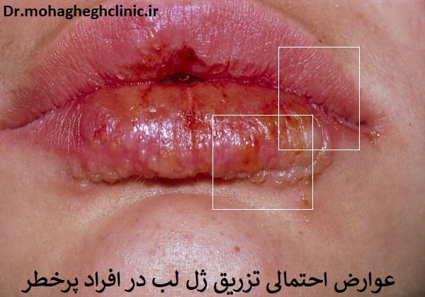 عوارض احتمالی تزریق ژل لب در افراد پرخطر