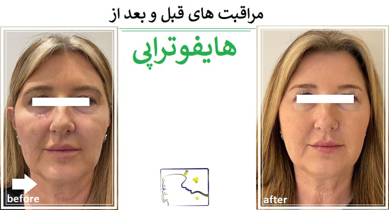 مراقبت های قبل و بعد از هایفوتراپی