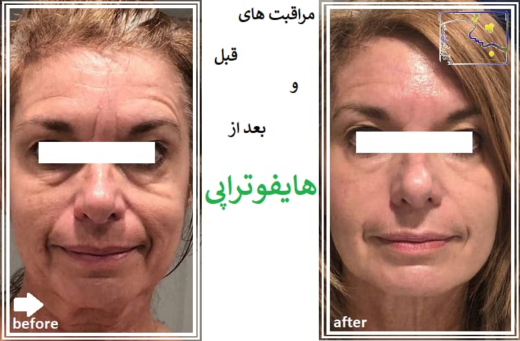 مراقبت های قبل و بعد از هایفوتراپی