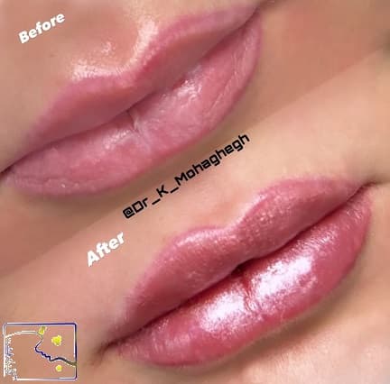 چه کسانی نباید ژل لب تزریق کنند؟
